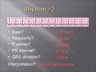 130 bpm• Rate?
• Regularity? regular
normal
0.08 s
• P waves?
• PR interval? 0.16 s
• QRS duration?
Interpretation? Sinus Tachycardia
 