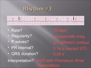 70 bpm• Rate?
• Regularity? occasionally irreg.
2/7 different contour
0.08 s
• P waves?
• PR interval? 0.14 s (except 2/7)
• QRS duration?
Interpretation? NSR with Premature Atrial
Contractions
 