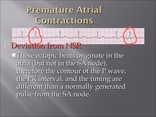  Deviation from NSRDeviation from NSR
These ectopic beats originate in theThese ectopic beats originate in the
atria (but not in the SA node),atria (but not in the SA node),
therefore the contour of the P wave,therefore the contour of the P wave,
the PR interval, and the timing arethe PR interval, and the timing are
different than a normally generateddifferent than a normally generated
pulse from the SA node.pulse from the SA node.
 