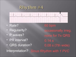 60 bpm• Rate?
• Regularity? occasionally irreg.
none for 7th QRS
0.08 s (7th wide)
• P waves?
• PR interval? 0.14 s
• QRS duration?
Interpretation? Sinus Rhythm with 1 PVC
 