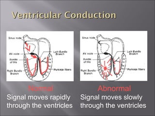 Normal
Signal moves rapidly
through the ventricles
Abnormal
Signal moves slowly
through the ventricles
 