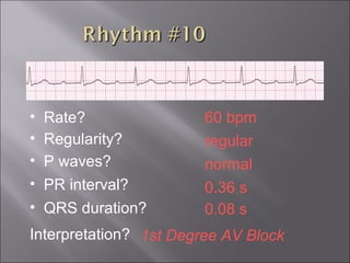 60 bpm• Rate?
• Regularity? regular
normal
0.08 s
• P waves?
• PR interval? 0.36 s
• QRS duration?
Interpretation? 1st Degree AV Block
 