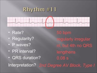 50 bpm• Rate?
• Regularity? regularly irregular
nl, but 4th no QRS
0.08 s
• P waves?
• PR interval? lengthens
• QRS duration?
Interpretation? 2nd Degree AV Block, Type I
 