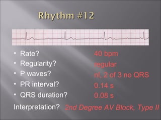 40 bpm• Rate?
• Regularity? regular
nl, 2 of 3 no QRS
0.08 s
• P waves?
• PR interval? 0.14 s
• QRS duration?
Interpretation? 2nd Degree AV Block, Type II
 