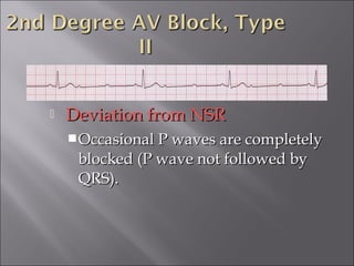  Deviation from NSRDeviation from NSR
Occasional P waves are completelyOccasional P waves are completely
blocked (P wave not followed byblocked (P wave not followed by
QRS).QRS).
 
