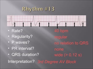 40 bpm• Rate?
• Regularity? regular
no relation to QRS
wide (> 0.12 s)
• P waves?
• PR interval? none
• QRS duration?
Interpretation? 3rd Degree AV Block
 