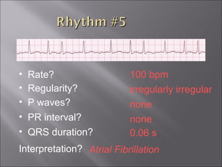 100 bpm• Rate?
• Regularity? irregularly irregular
none
0.06 s
• P waves?
• PR interval? none
• QRS duration?
Interpretation? Atrial Fibrillation
 