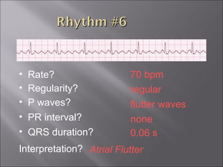 70 bpm• Rate?
• Regularity? regular
flutter waves
0.06 s
• P waves?
• PR interval? none
• QRS duration?
Interpretation? Atrial Flutter
 