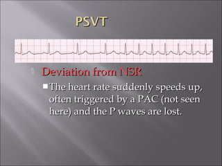  Deviation from NSRDeviation from NSR
The heart rate suddenly speeds up,The heart rate suddenly speeds up,
often triggered by a PAC (not seenoften triggered by a PAC (not seen
here) and the P waves are lost.here) and the P waves are lost.
 