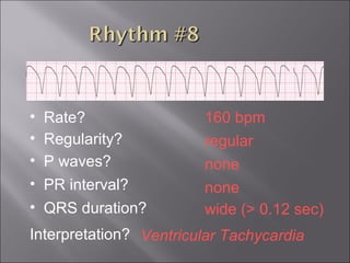160 bpm• Rate?
• Regularity? regular
none
wide (> 0.12 sec)
• P waves?
• PR interval? none
• QRS duration?
Interpretation? Ventricular Tachycardia
 