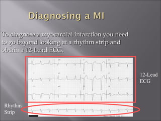 To diagnose a myocardial infarction you needTo diagnose a myocardial infarction you need
to go beyond looking at a rhythm strip andto go beyond looking at a rhythm strip and
obtain a 12-Lead ECG.obtain a 12-Lead ECG.
Rhythm
Strip
12-Lead
ECG
 
