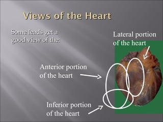 Some leads get aSome leads get a
good view of the:good view of the:
Anterior portion
of the heart
Lateral portion
of the heart
Inferior portion
of the heart
 