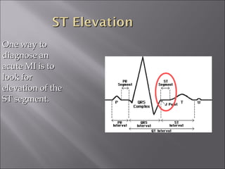 One way toOne way to
diagnose andiagnose an
acute MI is toacute MI is to
look forlook for
elevation of theelevation of the
ST segment.ST segment.
 