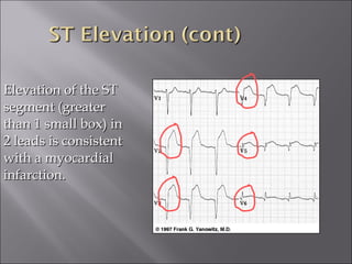 Elevation of the STElevation of the ST
segment (greatersegment (greater
than 1 small box) inthan 1 small box) in
2 leads is consistent2 leads is consistent
with a myocardialwith a myocardial
infarction.infarction.
 