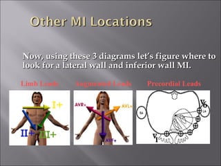 Now, using these 3 diagrams let’s figure where toNow, using these 3 diagrams let’s figure where to
look for a lateral wall and inferior wall MI.look for a lateral wall and inferior wall MI.
Limb Leads Augmented Leads Precordial Leads
 
