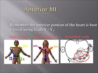 Remember the anterior portion of the heart is bestRemember the anterior portion of the heart is best
viewed using leads Vviewed using leads V11- V- V44..
Limb Leads Augmented Leads Precordial Leads
 