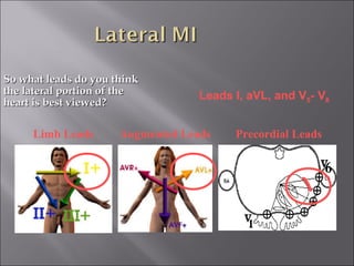 So what leads do you thinkSo what leads do you think
the lateral portion of thethe lateral portion of the
heart is best viewed?heart is best viewed?
Limb Leads Augmented Leads Precordial Leads
Leads I, aVL, and V5- V6
 