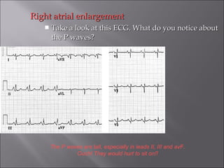 Right atrial enlargementRight atrial enlargement
 Take a look at this ECG. What do you notice aboutTake a look at this ECG. What do you notice about
the P waves?the P waves?
The P waves are tall, especially in leads II, III and avF.
Ouch! They would hurt to sit on!!
 
