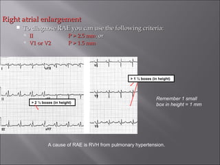 Right atrial enlargementRight atrial enlargement
 To diagnose RAE you can use the following criteria:To diagnose RAE you can use the following criteria:
 IIII P > 2.5 mmP > 2.5 mm, or, or
 V1 or V2V1 or V2 P > 1.5 mmP > 1.5 mm
Remember 1 small
box in height = 1 mm
A cause of RAE is RVH from pulmonary hypertension.
> 2 ½ boxes (in height)
> 1 ½ boxes (in height)
 