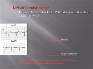 Left atrial enlargementLeft atrial enlargement
 Take a look at this ECG. What do you notice aboutTake a look at this ECG. What do you notice about
the P waves?the P waves?
The P waves in lead II are notched and in lead V1 they
have a deep and wide negative component.
Notched
Negative deflection
 