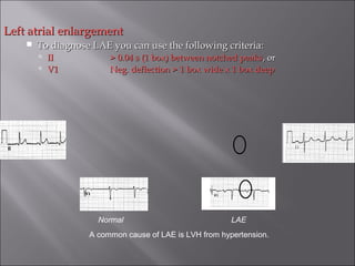 Left atrial enlargementLeft atrial enlargement
 To diagnose LAE you can use the following criteria:To diagnose LAE you can use the following criteria:
 IIII > 0.04 s (1 box) between notched peaks> 0.04 s (1 box) between notched peaks, or, or
 V1V1 Neg. deflection > 1 box wide x 1 box deepNeg. deflection > 1 box wide x 1 box deep
Normal LAE
A common cause of LAE is LVH from hypertension.
 