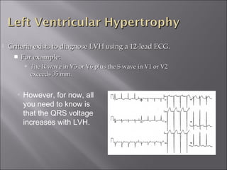  Criteria exists to diagnose LVH using a 12-lead ECG.Criteria exists to diagnose LVH using a 12-lead ECG.
 For example:For example:
 The R wave in V5 or V6 plus the S wave in V1 or V2The R wave in V5 or V6 plus the S wave in V1 or V2
exceeds 35 mm.exceeds 35 mm.
• However, for now, all
you need to know is
that the QRS voltage
increases with LVH.
 
