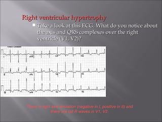 Right ventricular hypertrophyRight ventricular hypertrophy
 Take a look at this ECG. What do you notice aboutTake a look at this ECG. What do you notice about
the axis and QRS complexes over the rightthe axis and QRS complexes over the right
ventricle (V1, V2)?ventricle (V1, V2)?
There is right axis deviation (negative in I, positive in II) and
there are tall R waves in V1, V2.
 