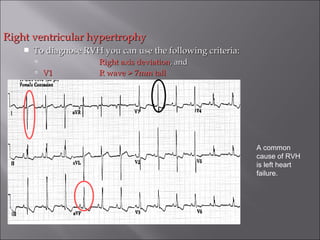 Right ventricular hypertrophyRight ventricular hypertrophy
 To diagnose RVH you can use the following criteria:To diagnose RVH you can use the following criteria:
 Right axis deviationRight axis deviation, and, and
 V1V1 R wave > 7mm tallR wave > 7mm tall
A common
cause of RVH
is left heart
failure.
 
