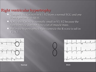 Right ventricular hypertrophyRight ventricular hypertrophy
 Compare the R waves in V1, V2 from a normal ECG and oneCompare the R waves in V1, V2 from a normal ECG and one
from a person with RVH.from a person with RVH.
 Notice the R wave is normally small in V1, V2 because theNotice the R wave is normally small in V1, V2 because the
right ventricle does not have a lot of muscle mass.right ventricle does not have a lot of muscle mass.
 But in the hypertrophied right ventricle the R wave is tall inBut in the hypertrophied right ventricle the R wave is tall in
V1, V2.V1, V2.
Normal RVH
 