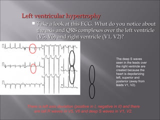 Left ventricular hypertrophyLeft ventricular hypertrophy
 Take a look at this ECG. What do you notice aboutTake a look at this ECG. What do you notice about
the axis and QRS complexes over the left ventriclethe axis and QRS complexes over the left ventricle
(V5, V6) and right ventricle (V1, V2)?(V5, V6) and right ventricle (V1, V2)?
There is left axis deviation (positive in I, negative in II) and there
are tall R waves in V5, V6 and deep S waves in V1, V2.
The deep S waves
seen in the leads over
the right ventricle are
created because the
heart is depolarizing
left, superior and
posterior (away from
leads V1, V2).
 