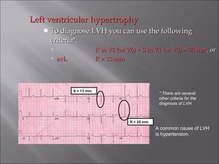 Left ventricular hypertrophyLeft ventricular hypertrophy
 To diagnose LVH you can use the followingTo diagnose LVH you can use the following
criteria*:criteria*:
 R in V5 (or V6) + S in V1 (or V2) > 35 mmR in V5 (or V6) + S in V1 (or V2) > 35 mm, or, or
 avLavL R > 13 mmR > 13 mm
A common cause of LVH
is hypertension.
* There are several
other criteria for the
diagnosis of LVH.
S = 13 mm
R = 25 mm
 