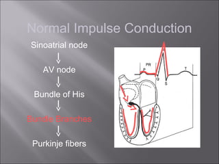 Normal Impulse Conduction
Sinoatrial node
AV node
Bundle of His
Bundle Branches
Purkinje fibers
 