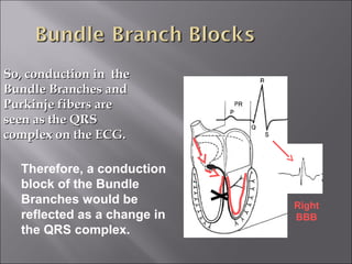 So, conduction in theSo, conduction in the
Bundle Branches andBundle Branches and
Purkinje fibers arePurkinje fibers are
seen as the QRSseen as the QRS
complex on the ECG.complex on the ECG.
Therefore, a conduction
block of the Bundle
Branches would be
reflected as a change in
the QRS complex.
Right
BBB
 