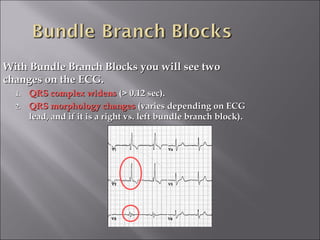 With Bundle Branch Blocks you will see twoWith Bundle Branch Blocks you will see two
changes on the ECG.changes on the ECG.
1.1. QRS complex widensQRS complex widens (> 0.12 sec)(> 0.12 sec)..
2.2. QRS morphology changesQRS morphology changes (varies depending on ECG(varies depending on ECG
lead, and if it is a right vs. left bundle branch block)lead, and if it is a right vs. left bundle branch block)..
 