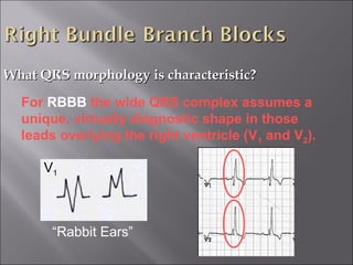 What QRS morphology is characteristic?What QRS morphology is characteristic?
V1
For RBBB the wide QRS complex assumes a
unique, virtually diagnostic shape in those
leads overlying the right ventricle (V1 and V2).
“Rabbit Ears”
 