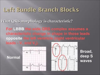 What QRS morphology is characteristic?What QRS morphology is characteristic?
For LBBB the wide QRS complex assumes a
characteristic change in shape in those leads
opposite the left ventricle (right ventricular
leads - V1 and V2).
Broad,
deep S
waves
Normal
 