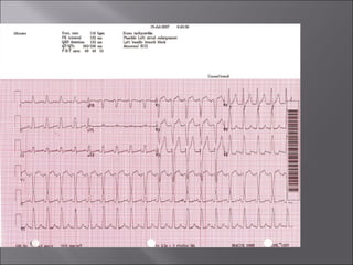 ECG BASICS IN DETAIL