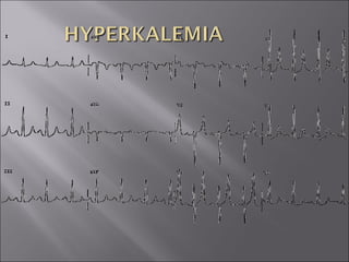ECG BASICS IN DETAIL