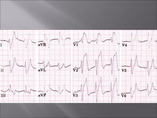 ECG BASICS IN DETAIL