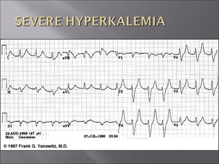 ECG BASICS IN DETAIL