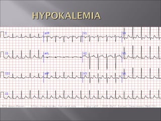ECG BASICS IN DETAIL