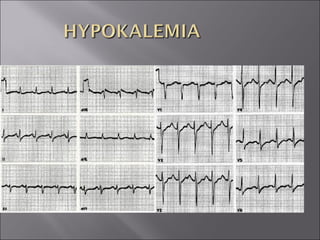 ECG BASICS IN DETAIL