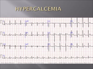 ECG BASICS IN DETAIL