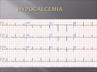 ECG BASICS IN DETAIL