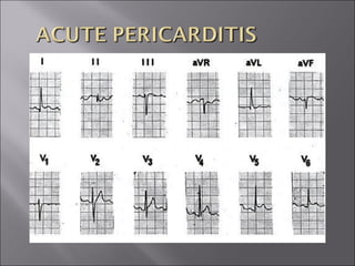 ECG BASICS IN DETAIL