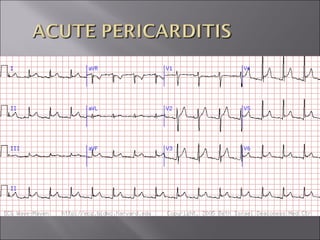 ECG BASICS IN DETAIL
