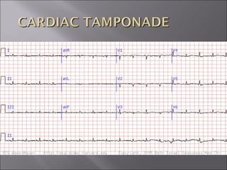 ECG BASICS IN DETAIL