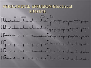 ECG BASICS IN DETAIL