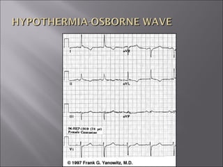 ECG BASICS IN DETAIL