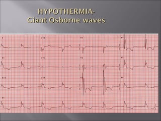 ECG BASICS IN DETAIL
